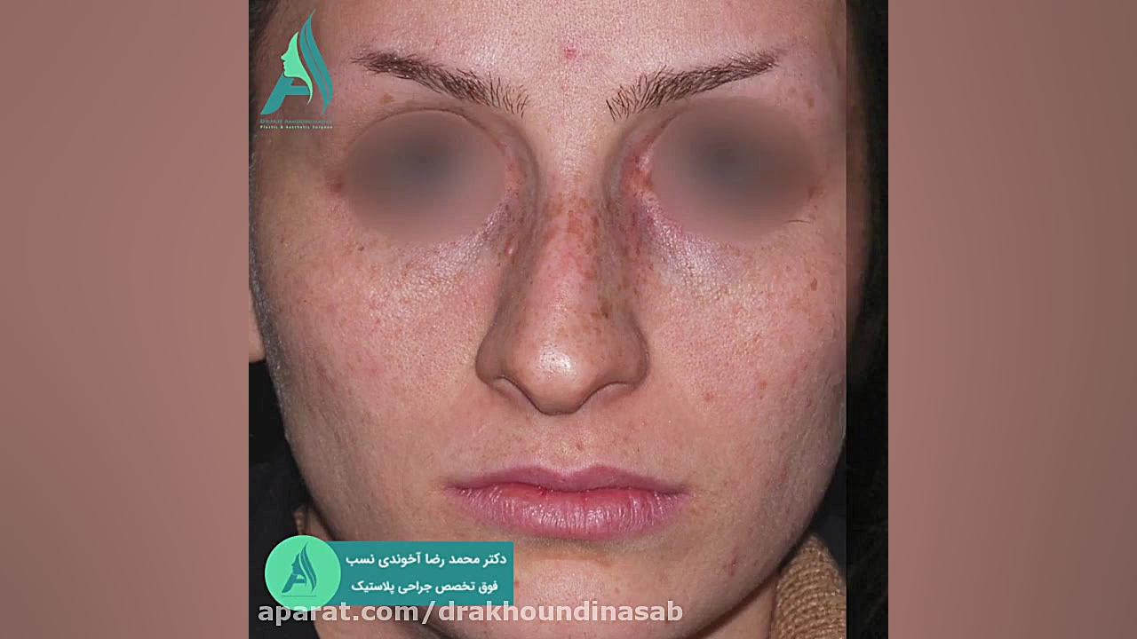 جراحی زیبایی بینی به صورت نیمه فانتزی دکتر محمدرضا آخوندی نسب-فوق تخصص جراحی پلاستیک