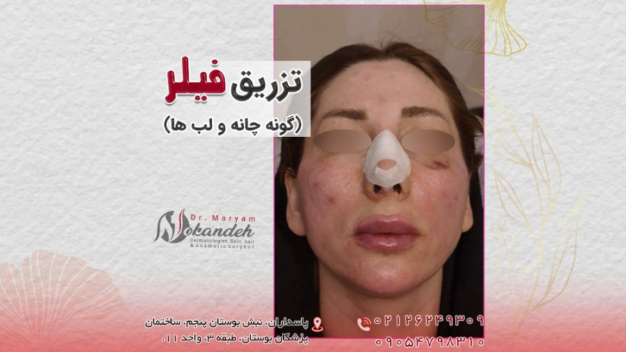 فیلم واقعی تزریق فیلر گونه، چانه و لب دکتر مریم نوکنده
