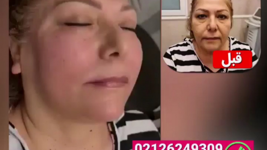فیلم قبل و بعد تزریق فیلر به کل صورت دکتر مریم نوکنده