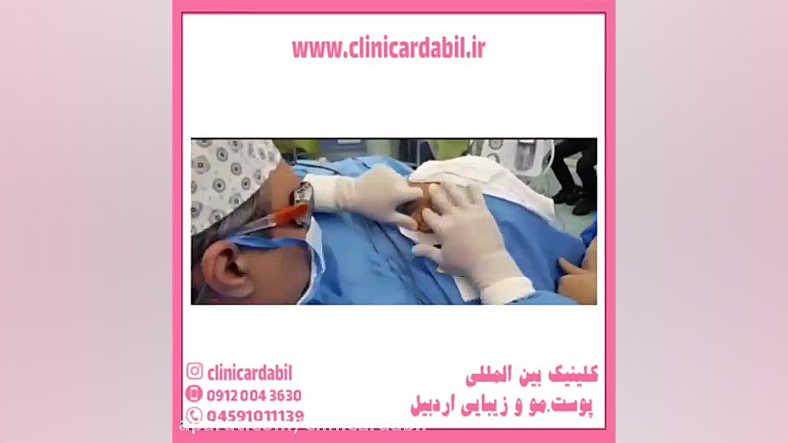 جراحی گوش برجسته یا لیفت گوش چیست ؟ مایکروگناتیا
