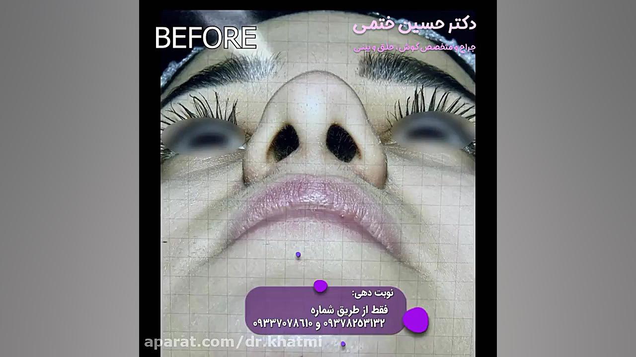 نمونه جراحی بینی گوشتی -دکتر حسین ختمی الکترود اپتوژنزی