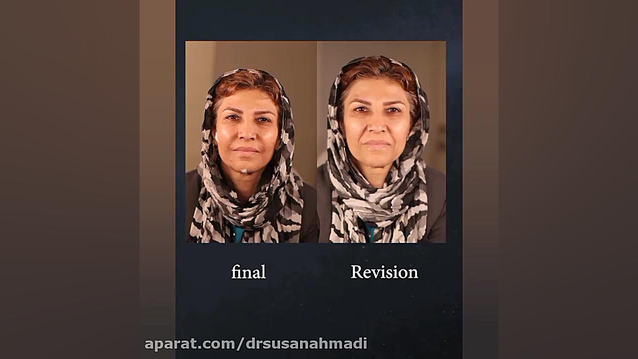 فیلم تزریق چربی به صورت دکتر سوسن احمدی پیر شهید