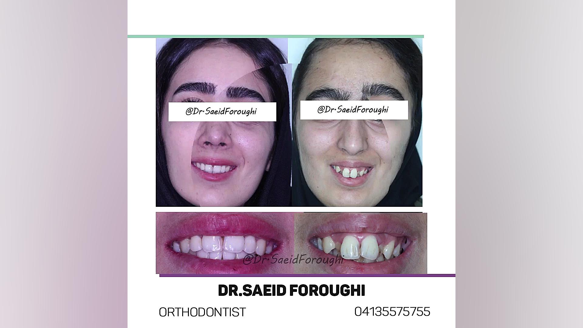 اصلاح فرم لبها و بیرون زدگی دندانها و ایجاد نمای زیبای لبخند توسط درمان ارتودنسی تزریق چربی