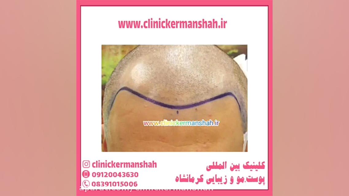 نحوه شستن موها و شامپو مناسب بعد از کاشت مو استوری