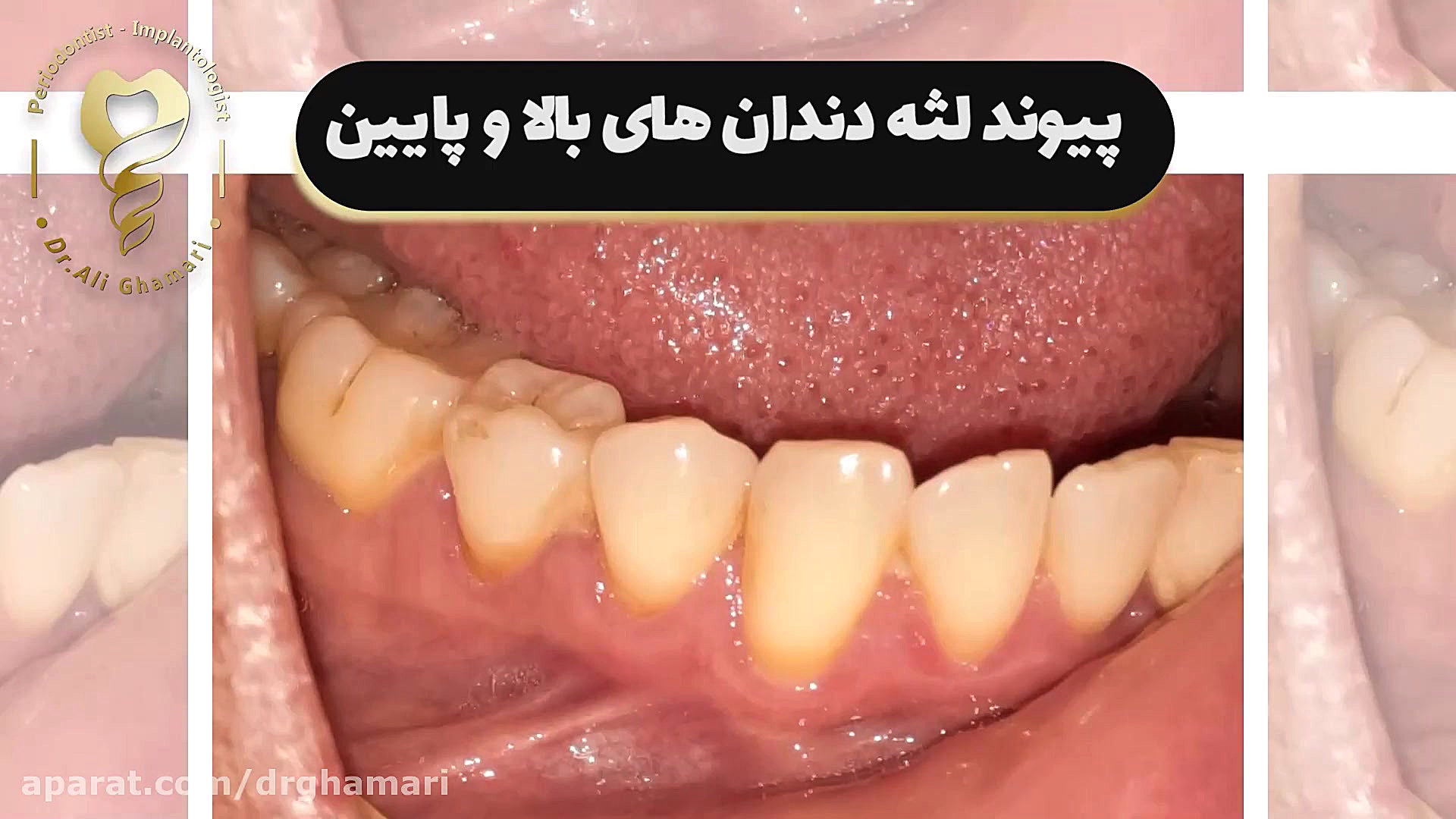 پیوند لثه دندان های بالا و پایین ژنراتور پالس عصبی