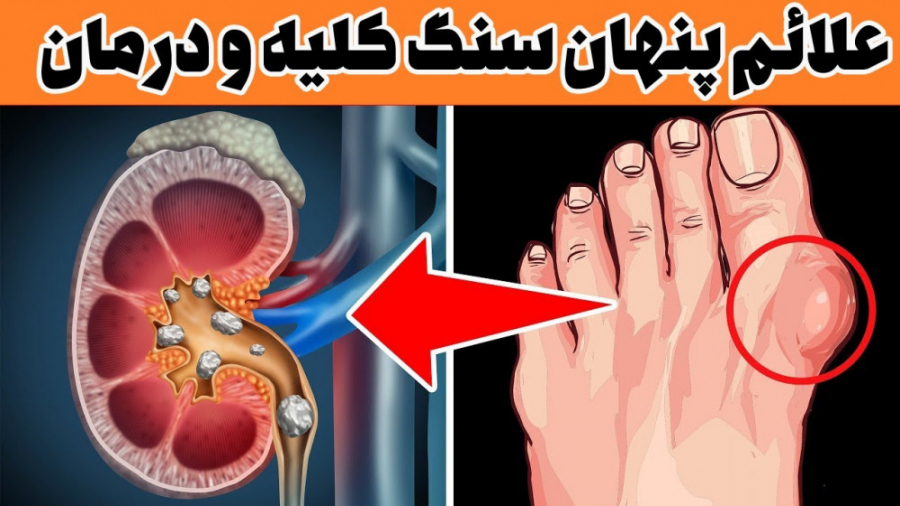 سنگ کلیه چیست و چگونه درمان می شود علائم آن پروتز دندان