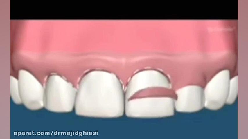 لیفت لثه دکترمجیدقیاسی