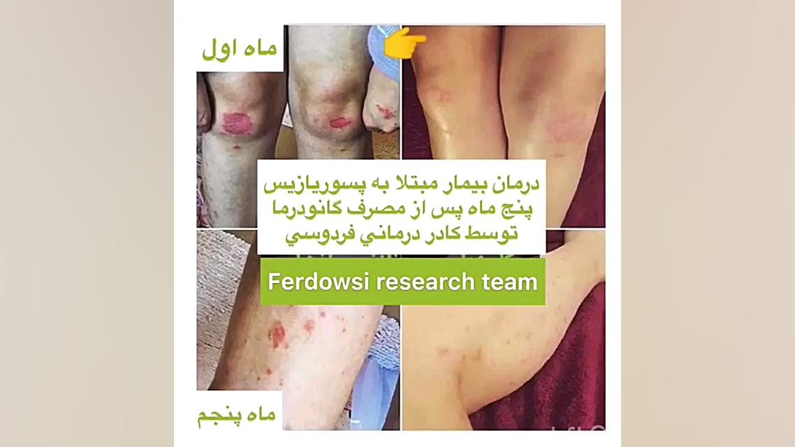 معجزه درمان پسوریازیس کشف شد! الناز شاکردوست