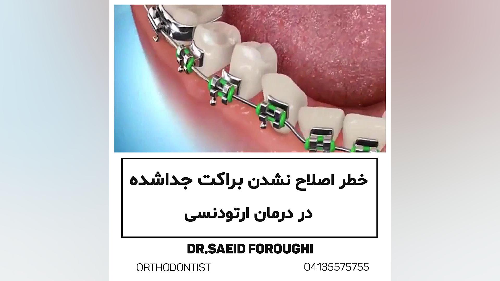 براکت جداشده از دندان نتیجه درمان ارتودنسی را تحت تأثیر قرار میدهد دکتر سعید فروغی متخصص ارتودنسی