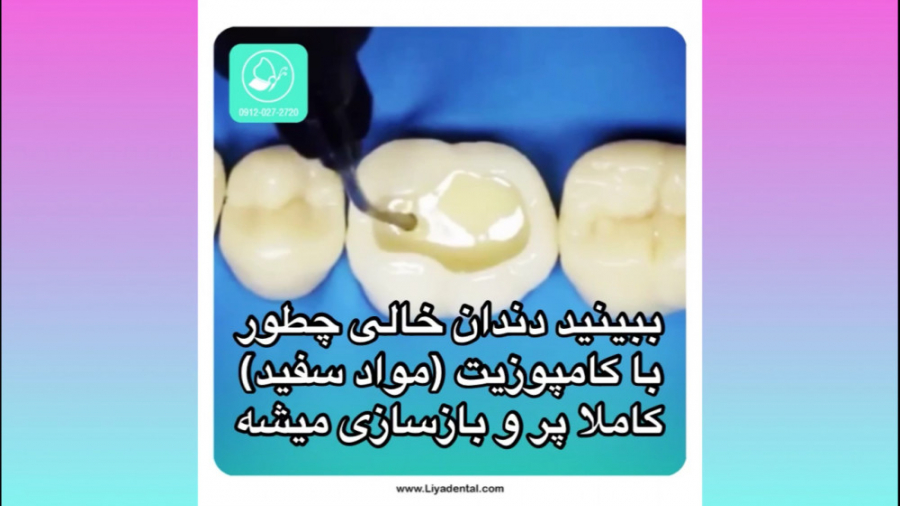 پر کردن دندان (ترمیم) در کلینیک دندانپزشکی لیا سندرم چیلبلینز