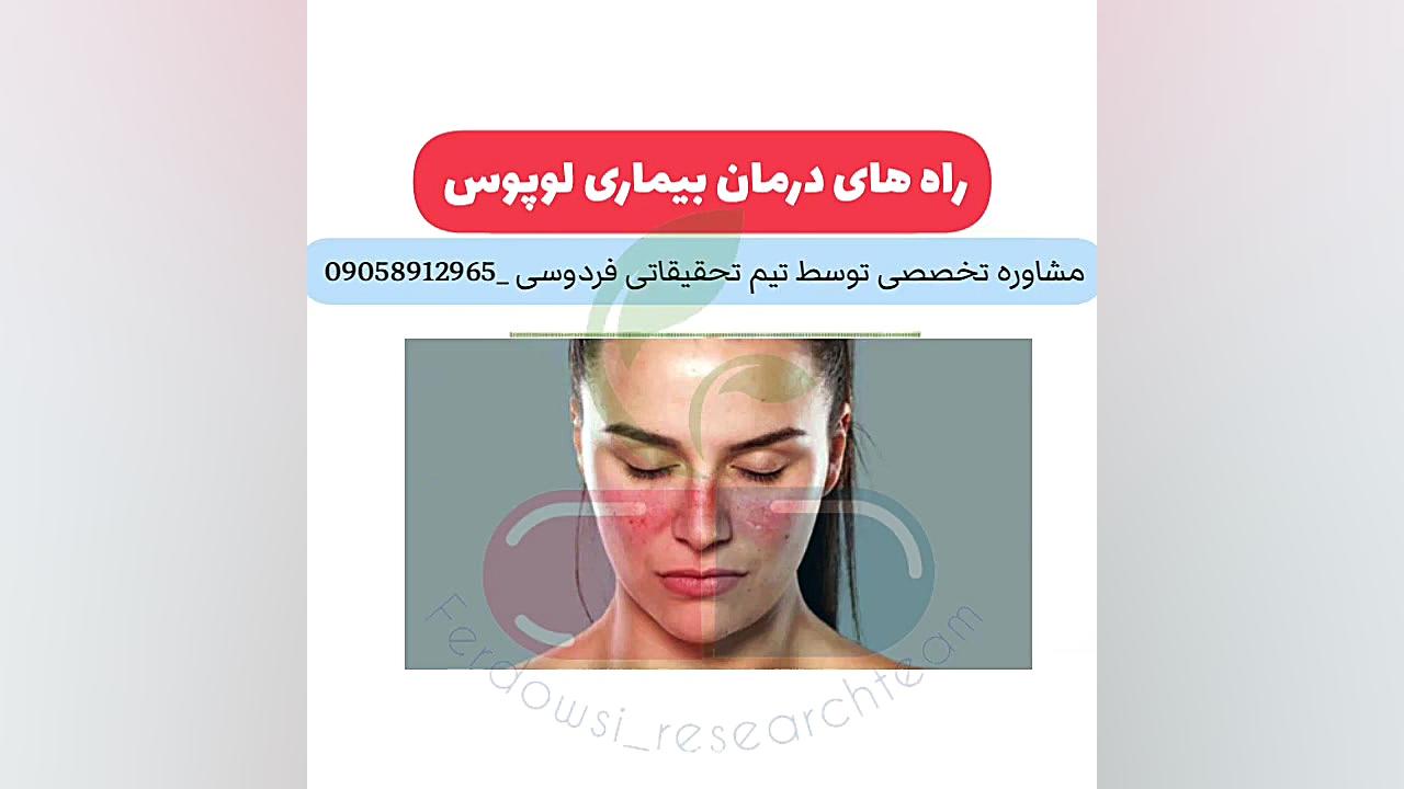 موثرترین راه درمان بیماری لوپوس چیست ؟ زیبایی پوست