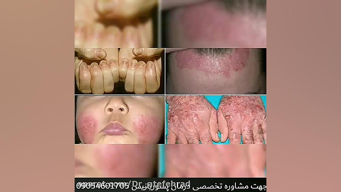 درمان پسوریازیس ناخن با دکتر خیراندیش دندانپزشکی کودکان