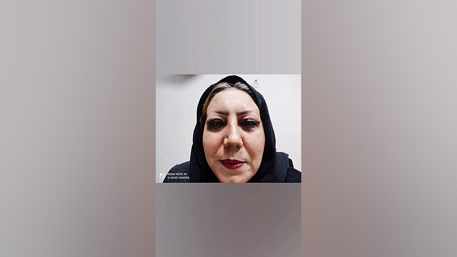 دکتر امیر بهزادی،متخصص جراحی عمومی،اصفهان-بلفاروپلاستی سرپایی اینسایزینگ