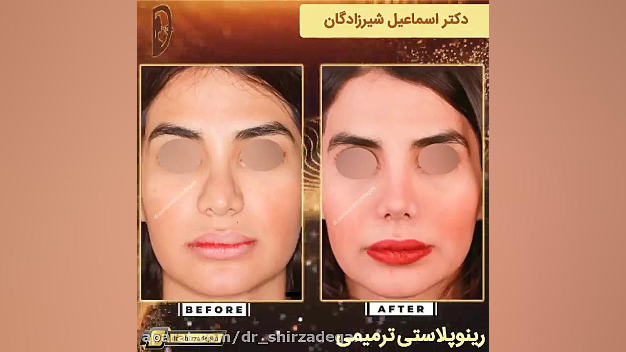 جراحی بینی ترمیمی دکتر اسماعیل شیرزادگان