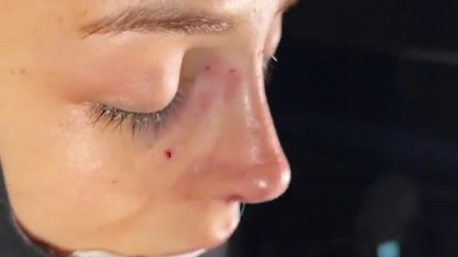 فیلم جراحی بینی ترمیمی لايو با پوست نازک و رتراکشن پره های بینی در اتاق عمل رادیوگرافی دندان