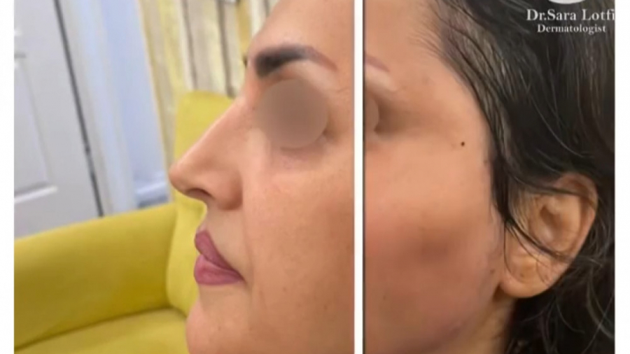 فیلم تزریق چربی به صورت دکتر سار ا لطفی