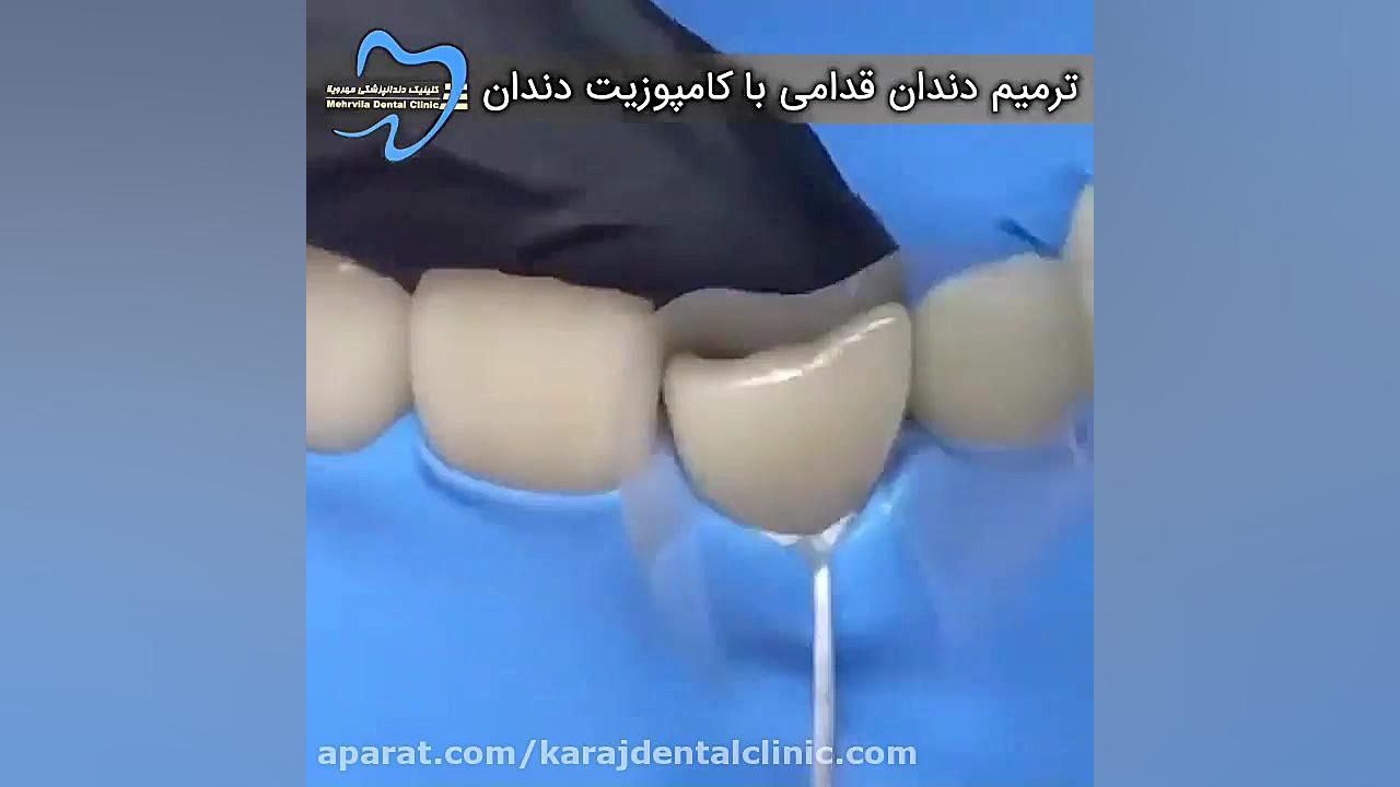 ترمیم دندان قدامی با کامپوزیت دندان منافذ باز پوست