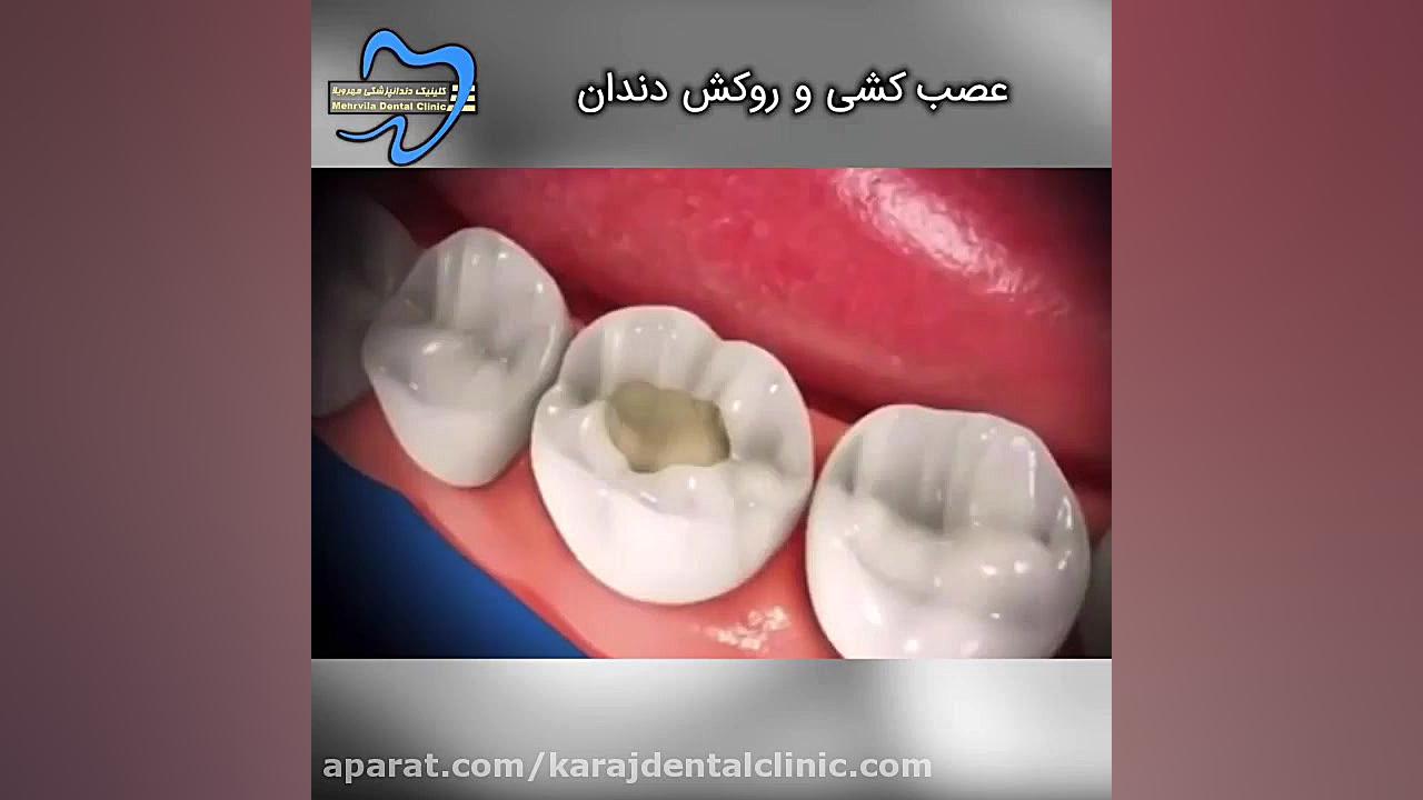 عصب کشی و روکش دندان ماموپلاستی