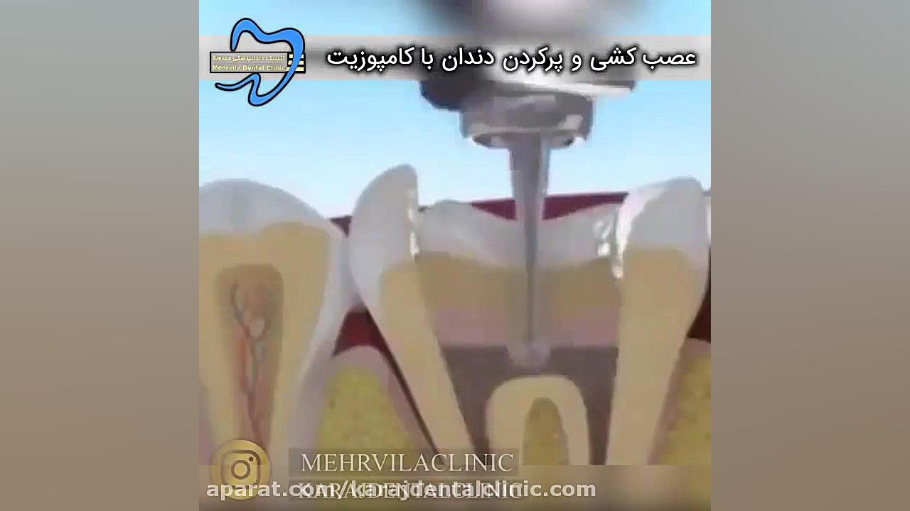 عصب کشی و پر کردن دندان با کامپوزیت دکتر پوست