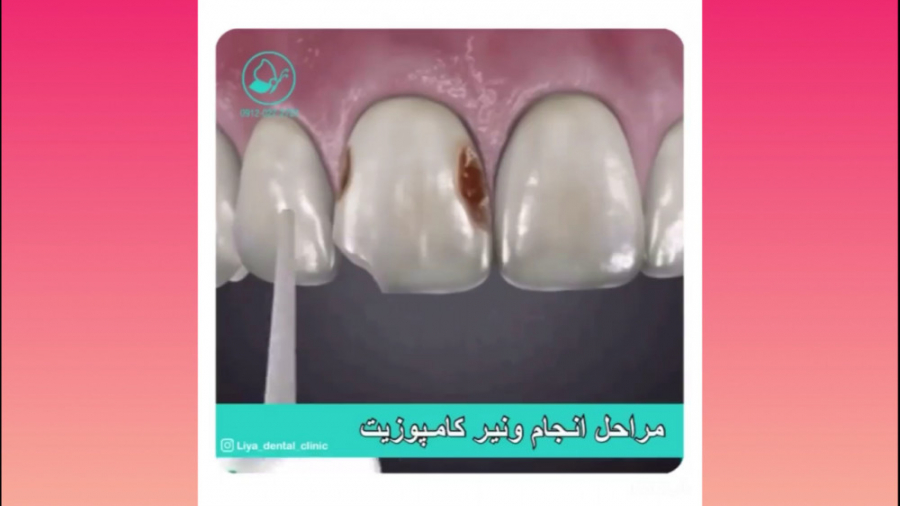 کامپوزیت ونیر در کلینیک دندانپزشکی لیا بیماری مایکلیناپاتی