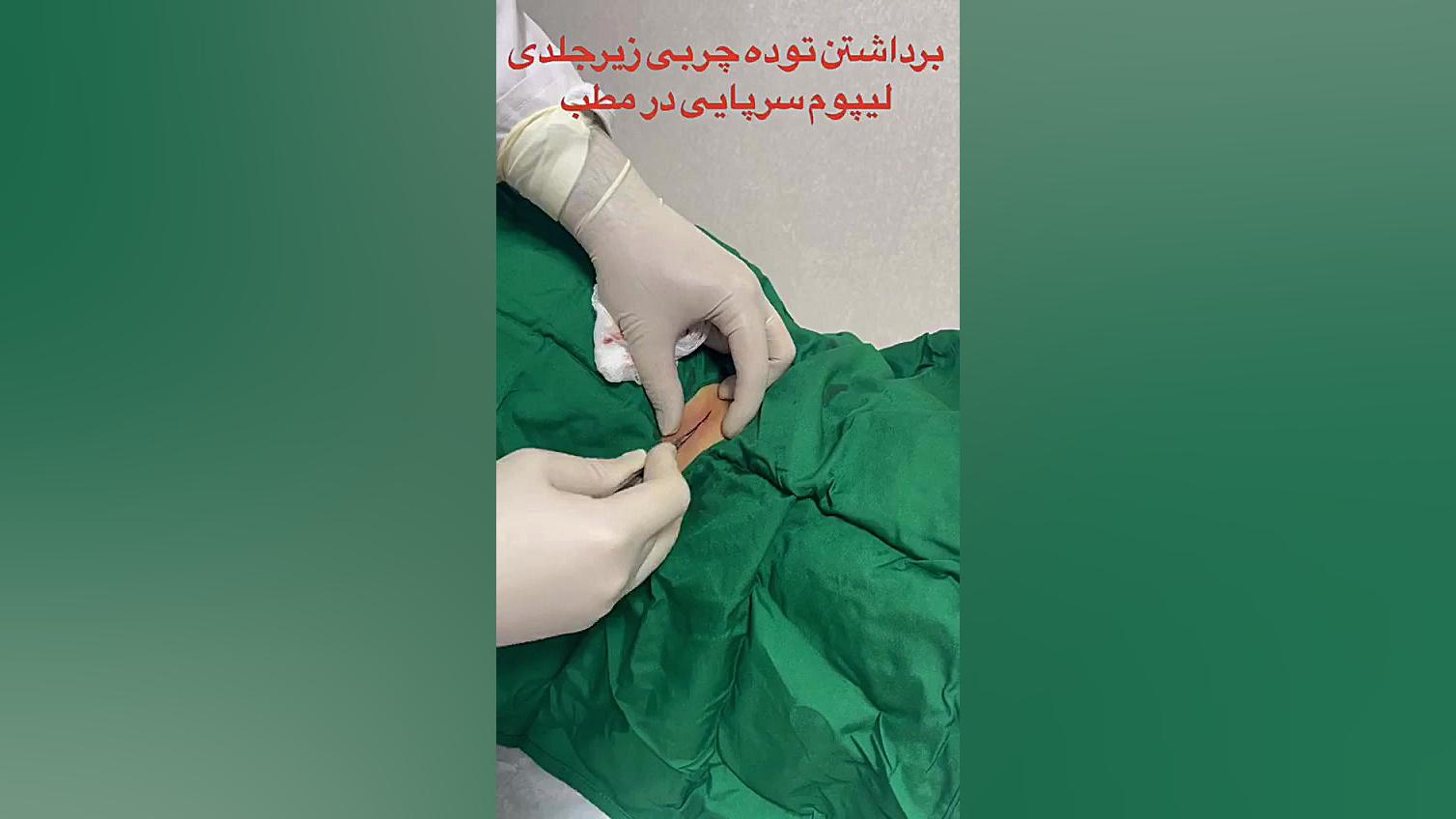 دکتر امیر بهزادی،متخصص جراحی عمومی،برداشتن توده چربی زیر جلدی لیپوم، اصفهان لیفت صورت