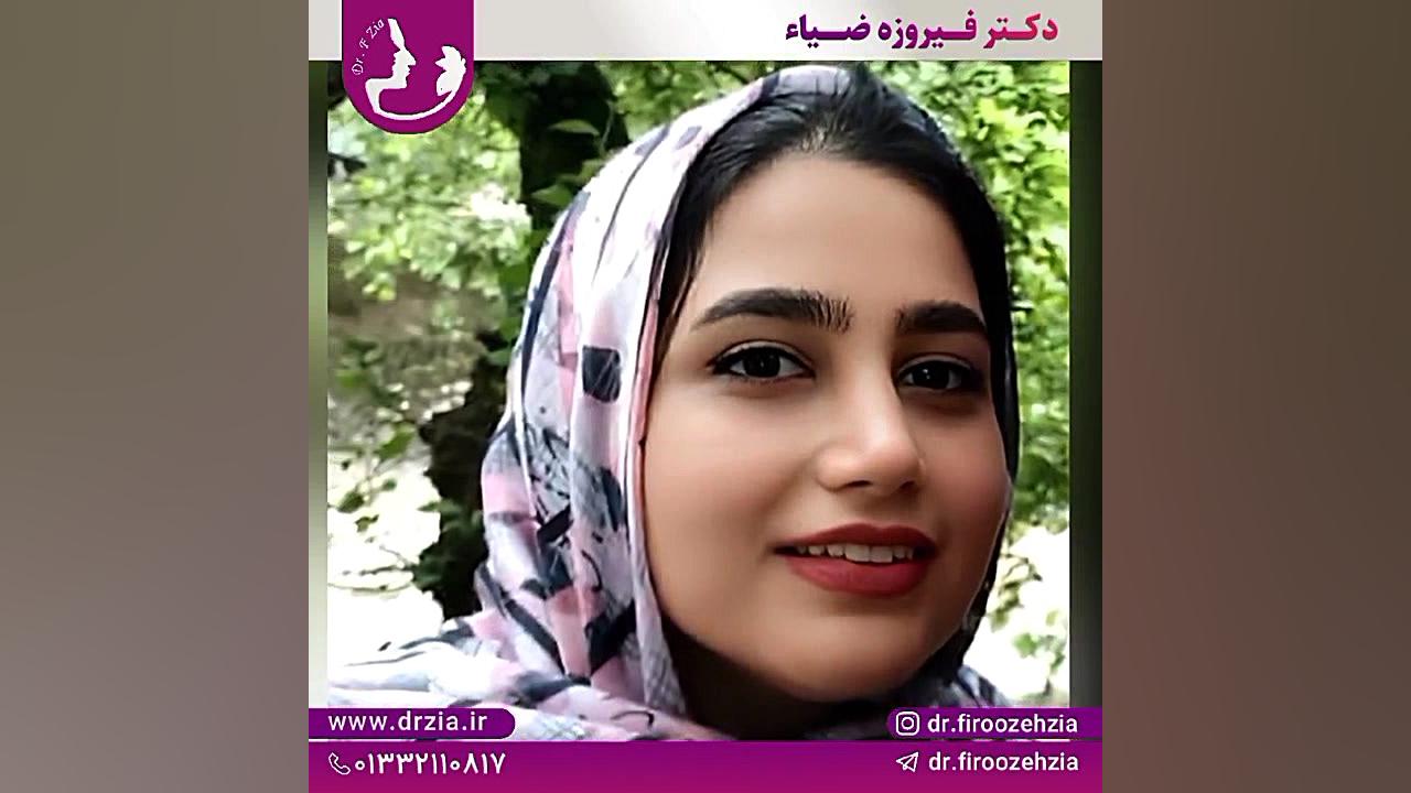 هفت ماه پس از جراحی بینی با انحراف شدید توسط دکتر فیروزه ضیاء متخصص گوش و حلق جوانسازی پوست