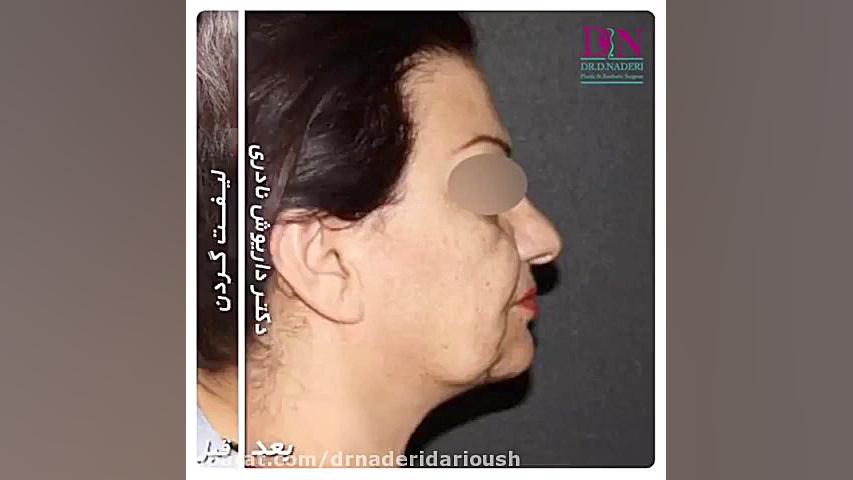 جراحی لیفت گردن دستگاه بیوسنسور عرق