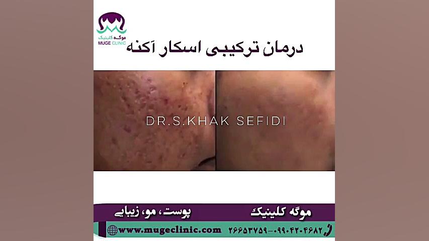 درمان ترکیبی اسکار آکنه-موگه کلینیک مزوتراپی