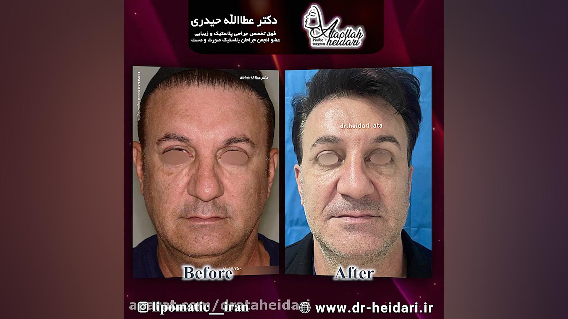 لیفت آندوسکوپی پیشانی بیماری سندروم آلاژیل
