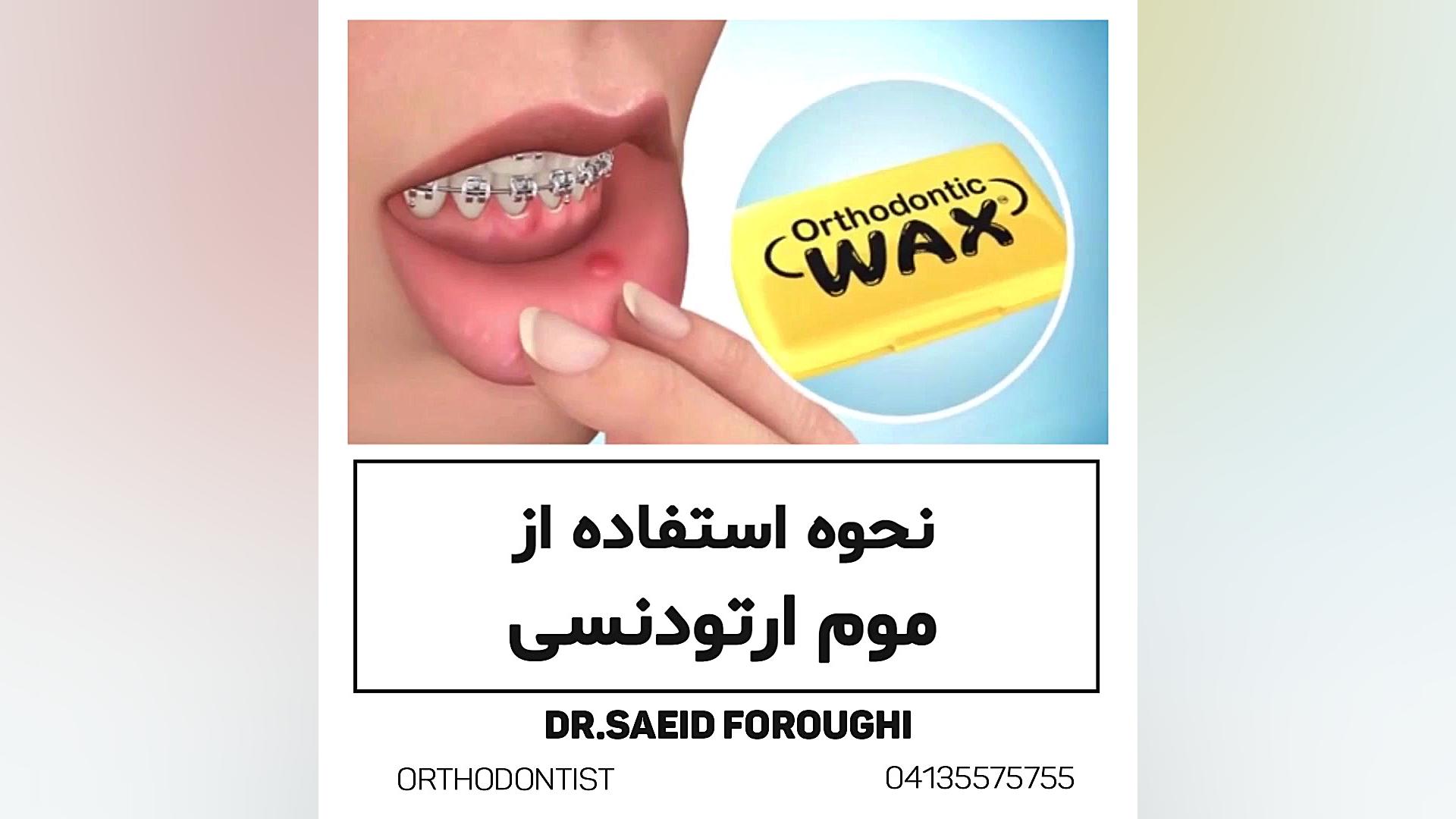 نحوه استفاده از موم ارتودنسی دکتر سعید فروغی متخصص ارتودنسی