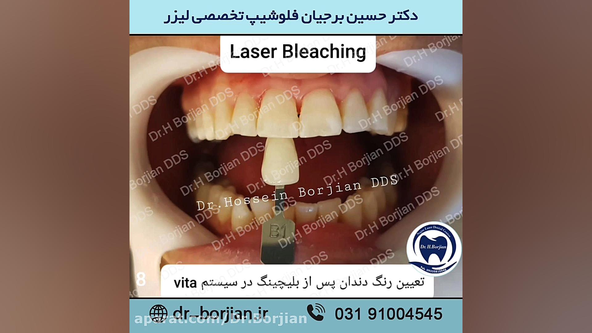 نمونه بلیچینگ دندان با لیزر (1) | بهترین جراح لثه اصفهان ایمونوانژیوگرافی