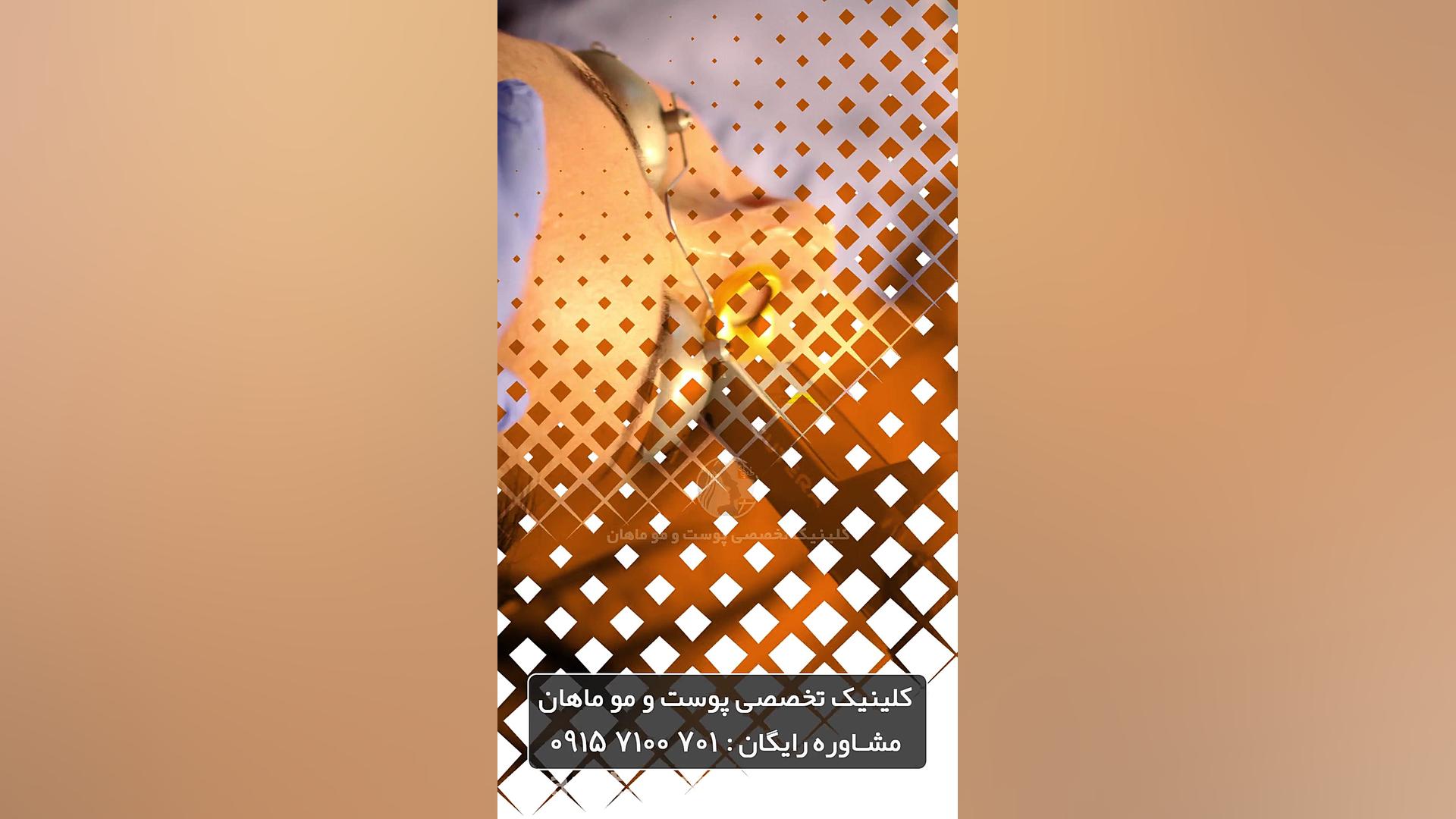 رفع ضایعات عروقی با دستگاه کوترای آمریکایی لیفت پیشانی