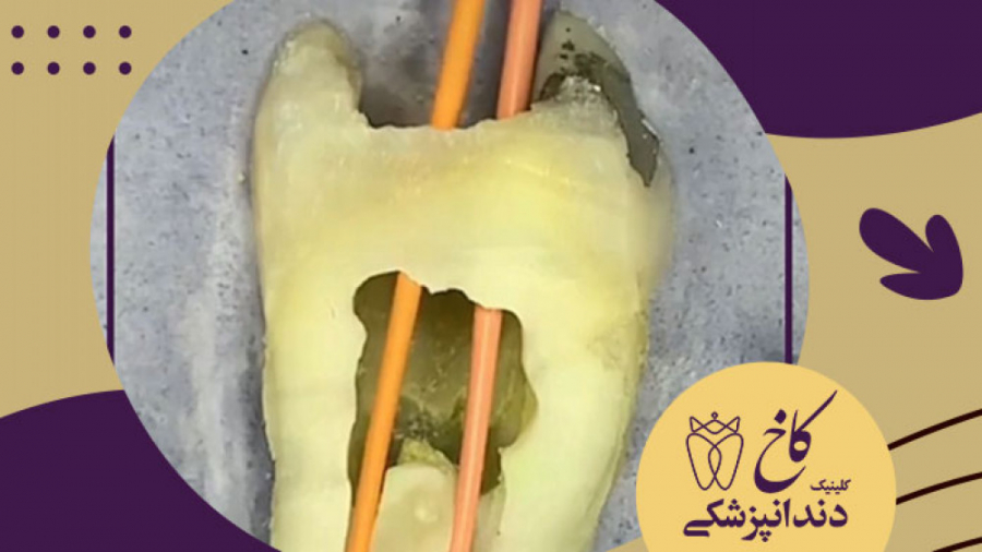 معالجه ریشه اینجوری انجام میشه کلینیک دندانپزشکی کاخ
