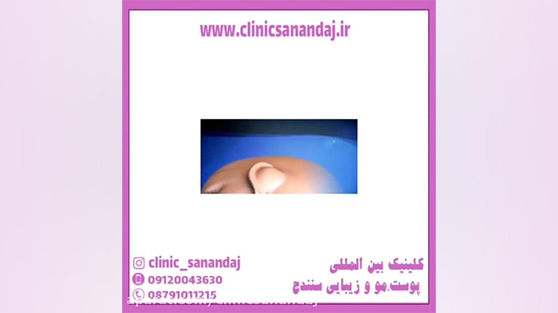 اتوپلاستی چیست و چگونه انجام می شود؟ تست دفع سدیم ادرار