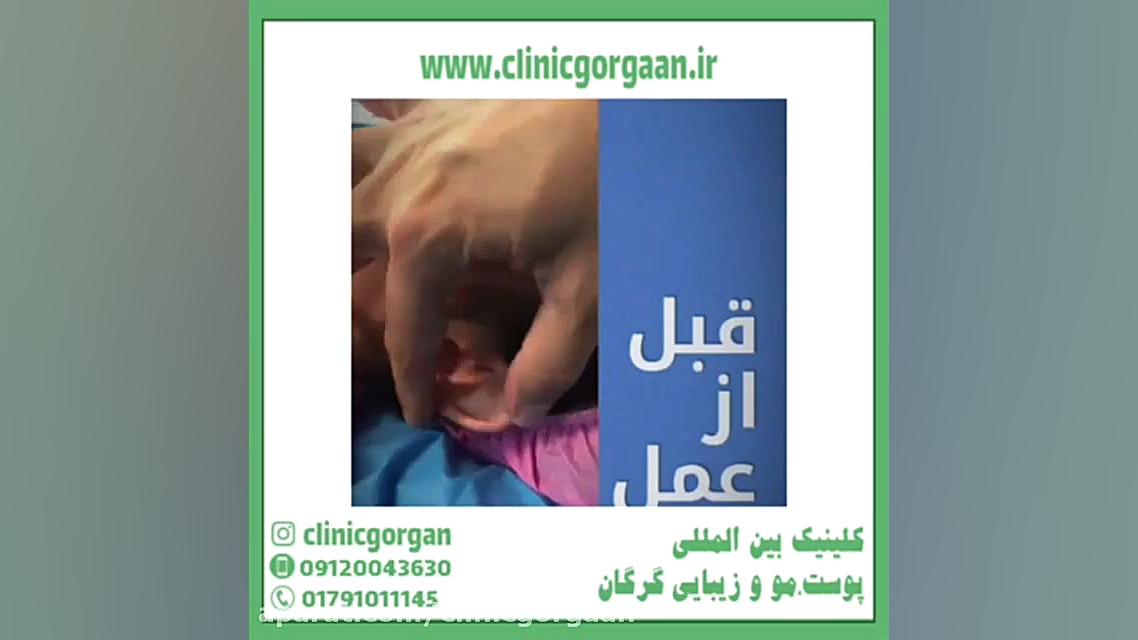 جراحی گوش برجسته یا لیفت گوش چیست ؟ بیولوژی تکوینی