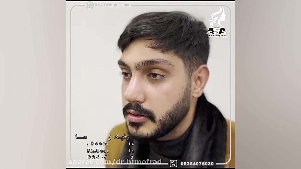 جراحی بینی مردانه دکتر حمیدرضا مفرد