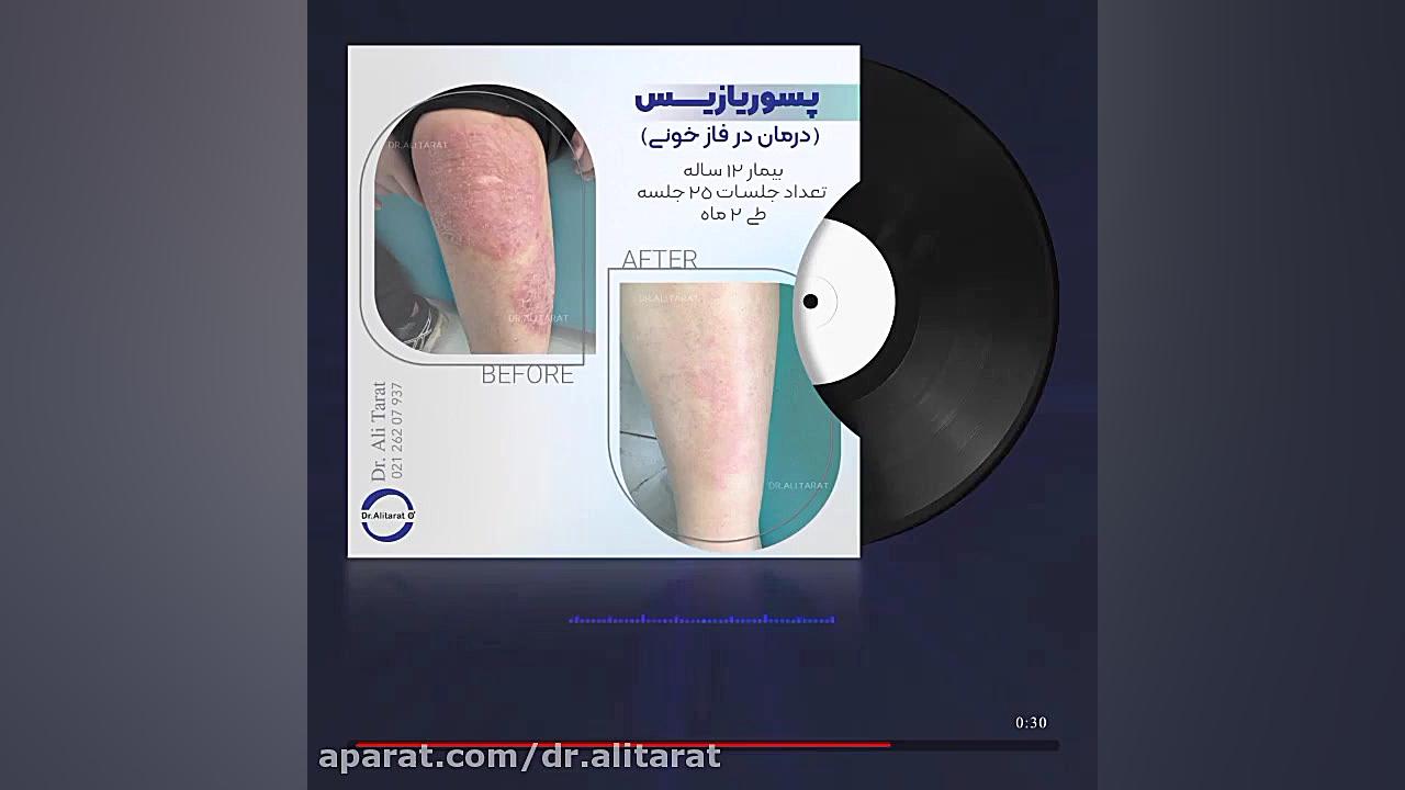 درمان پسوریازیس (فاز خونی) با اوزون درمانی اصلاح فرم صورت