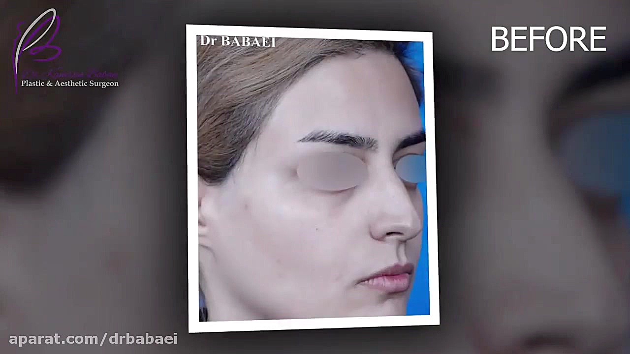 نمونه جراحی زیبایی بینی دکتر کامران بابایی