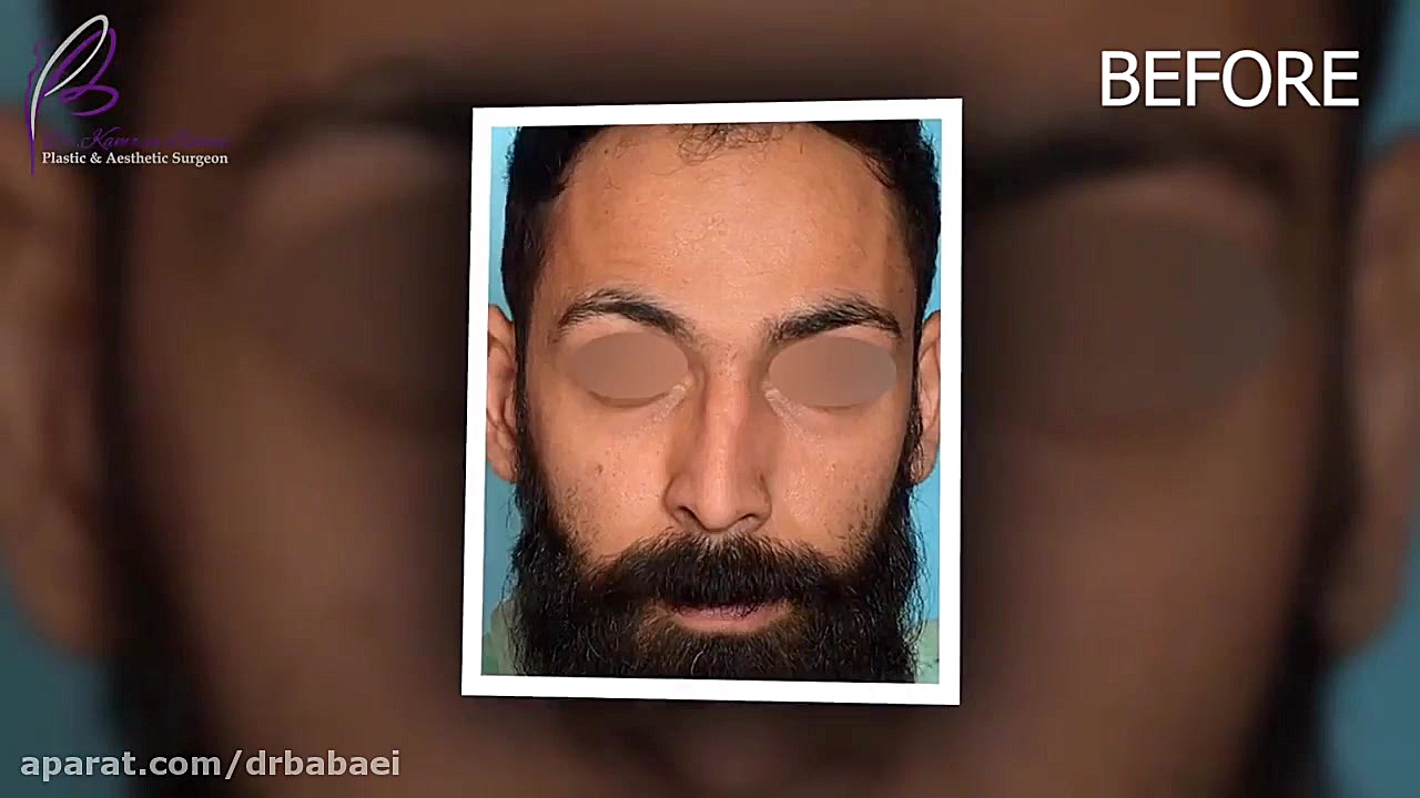 جراحی زیبایی بینی در آقایان دکتر کامران بابایی