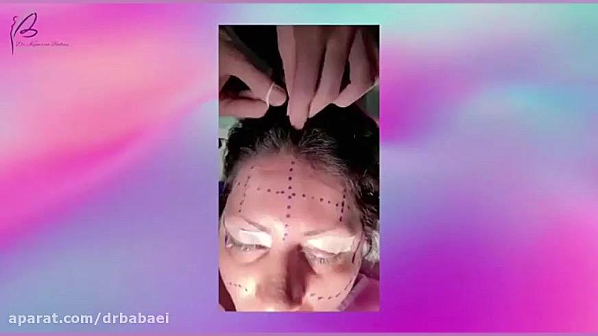 لیفت پیشانی با آندوسکوپ رزولین