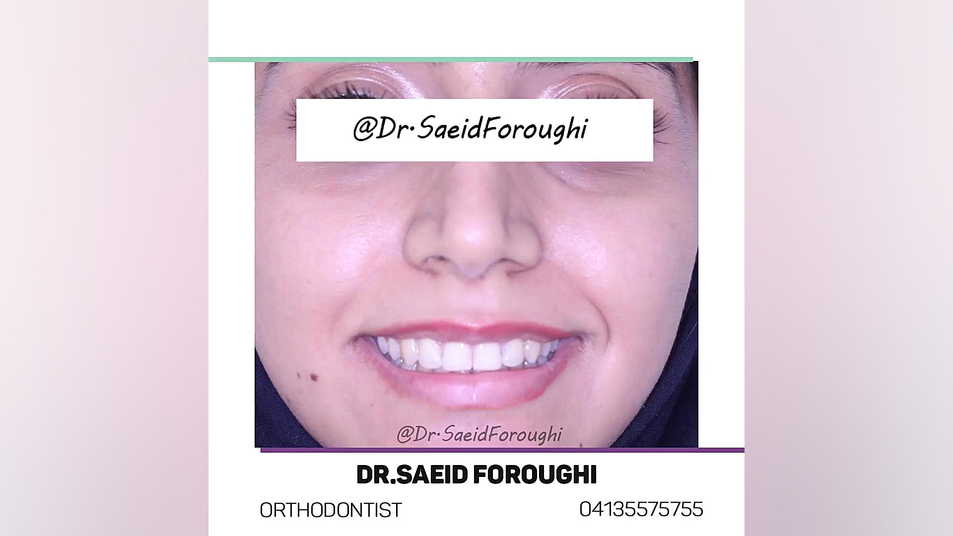 اصلاح نمای لبخند و عقب بودن فک پایین توسط درمان ترکیبی ارتودنسی ثابت و جراحی فک دکتر سعید فروغی متخصص ارتودنسی