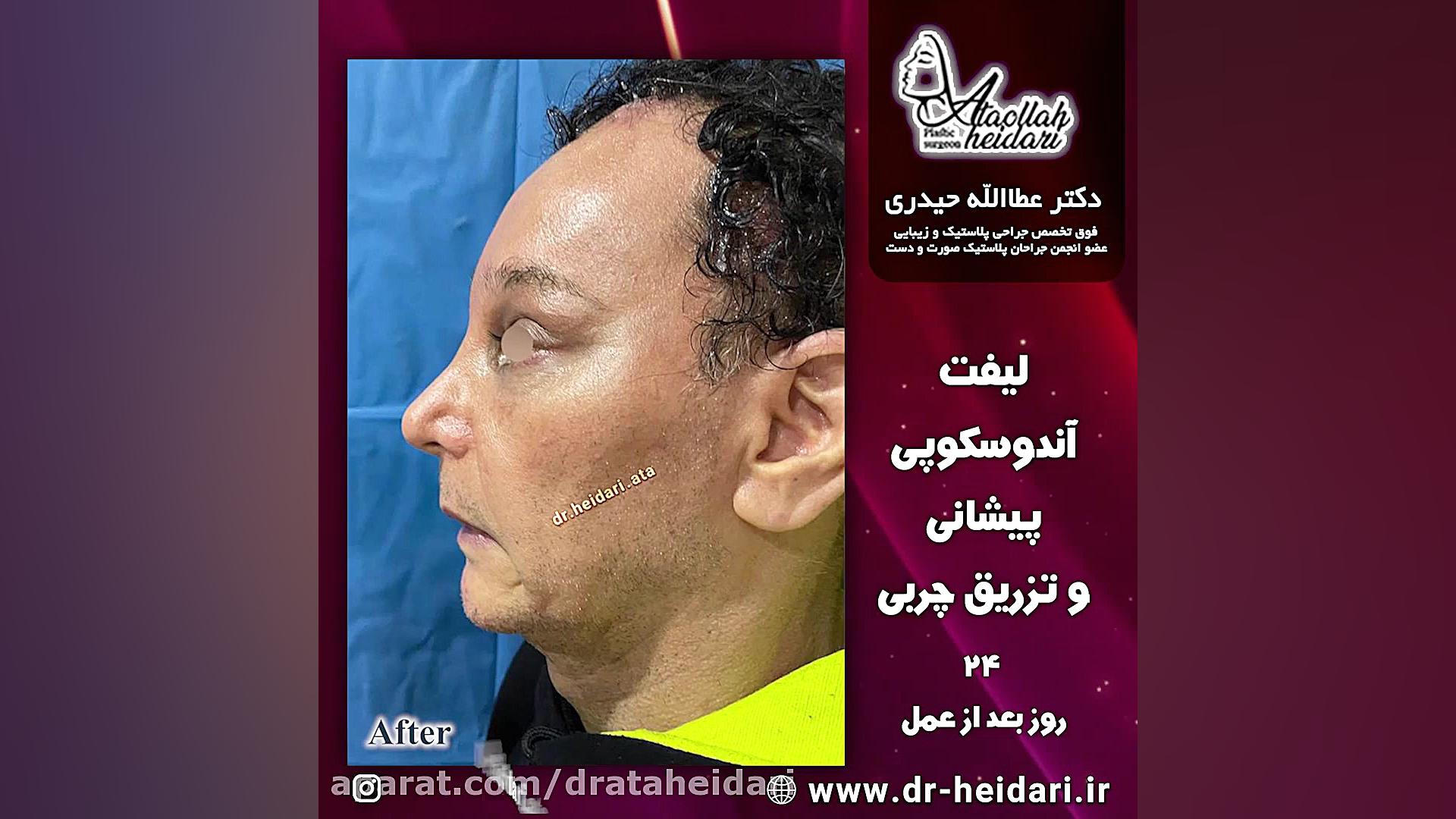 لیفت آندوسکوپی پیشانی و تزریق چربی ایلوبامید