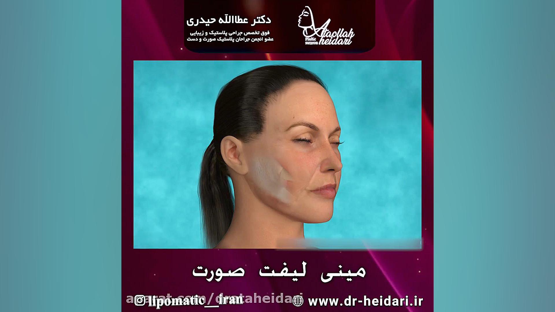 جراحی مینی لیفت صورت برداشتن توده