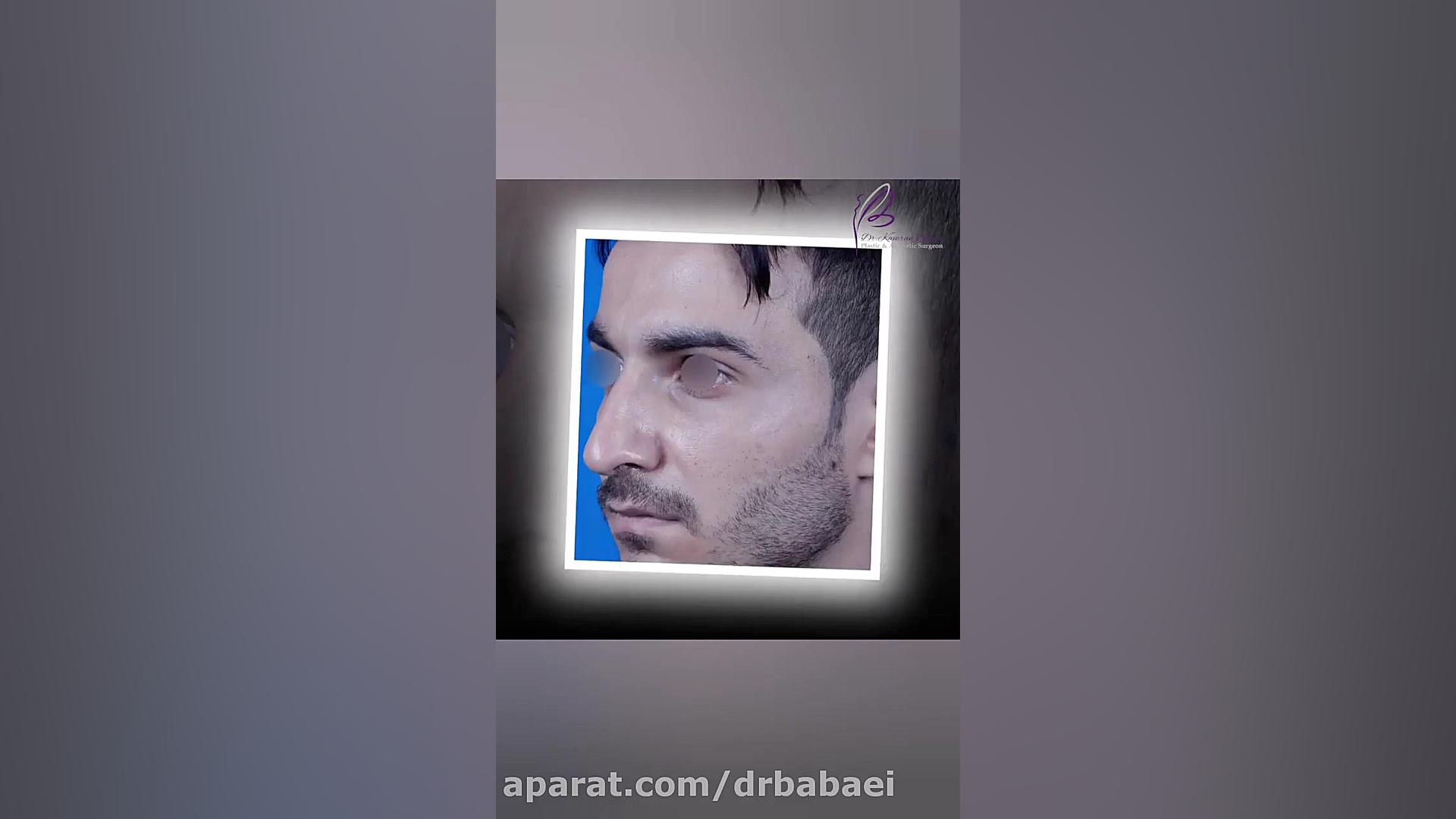 رینوپلاستی در آقایان دکتر کامران بابایی