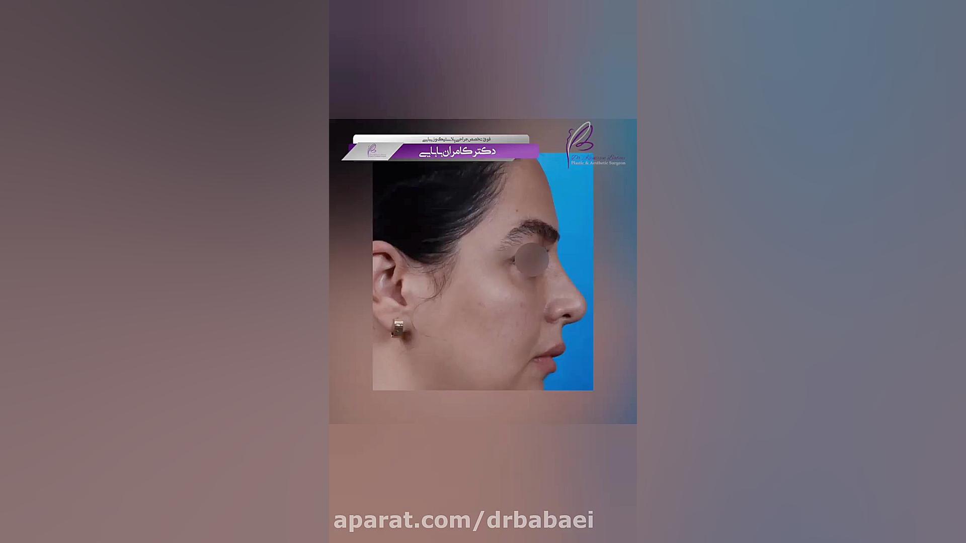 عمل لیفت آندوسکوپی ابرو و پیشانی دکتر کامران بابایی