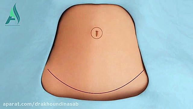 انیمیشن ابدومینوپلاستی شکم دکتر محمدرضا آخوندی نسب-فوق تخصص جراحی پلاستیک