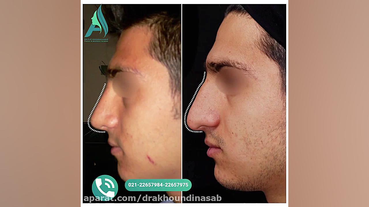 جراحی زیبایی بینی دکتر محمدرضا آخوندی نسب-فوق تخصص جراحی پلاستیک