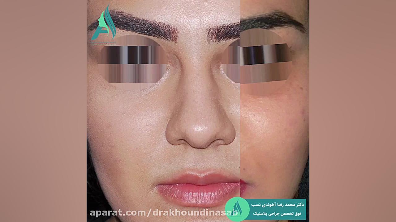 جراحی بینی گوشتی به صورت نیمه فانتزی دکتر محمدرضا آخوندی نسب-فوق تخصص جراحی پلاستیک