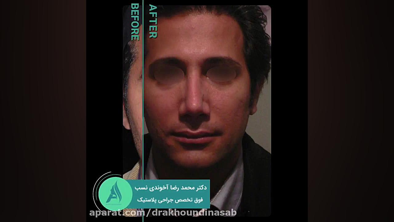 جراحی همزمان زیبایی و انحراف بینی دکتر محمدرضا آخوندی نسب-فوق تخصص جراحی پلاستیک