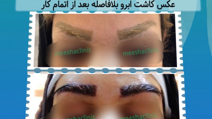 کاشت ابرو طبیعی در کلینیک میشا کلینیک میشا (دکتر سید حسن حسینی)